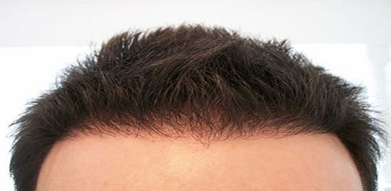 Saç Ekim İşlemleri