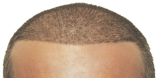 Doğal Görünmeyen Saçlar İçin Başarı Oranından Söz Edilemez!