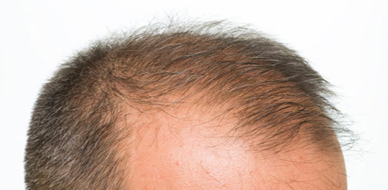 Saç Ekimi Operasyonu Ne Kadar Sürmektedir?